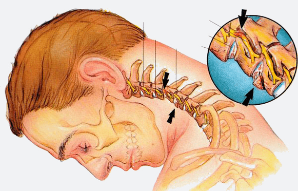 stages of osteochondrosis of the cervical spine